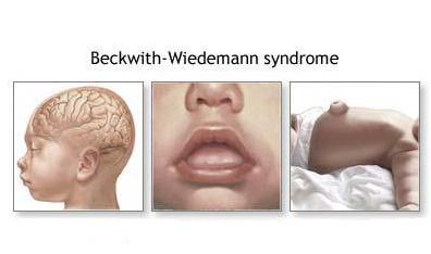 Beckwith Wiedemann症候群とは何ですか それはどのように現れていますか