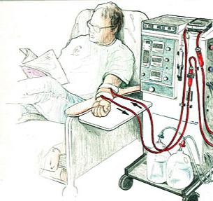 血液透析 - この手順は何ですか？