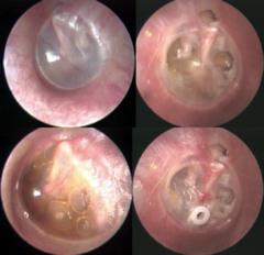 Catarrhal耳炎：症状、診断および治療