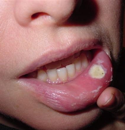 唇がんの症状 - どのようにそれらを認識するのですか？